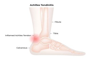 https://ayurved.harbors.in/wp-content/uploads/2023/12/diseases-joint-pain-tendinitis-320x213.jpg