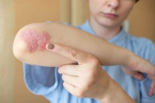Psoriasis women on her elbows, sitting on the bedroom floor. Concept dermatology, skin diseases and care